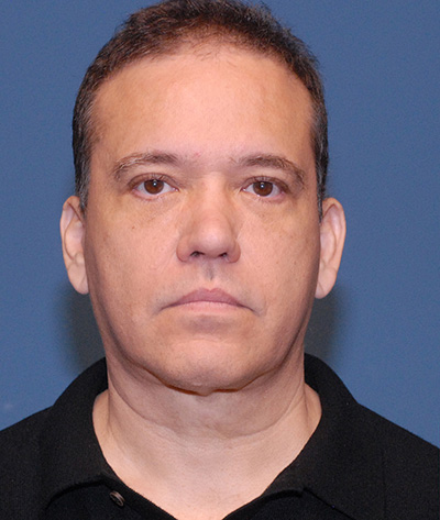 Blepharoplasty Before & After Image