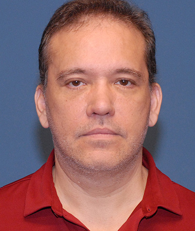 Blepharoplasty Before & After Image