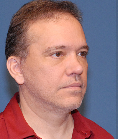 Blepharoplasty Before & After Image