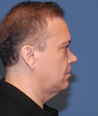Blepharoplasty Before & After Image