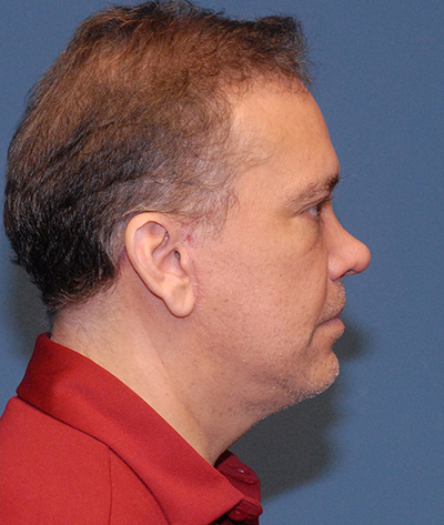 Blepharoplasty Before & After Image