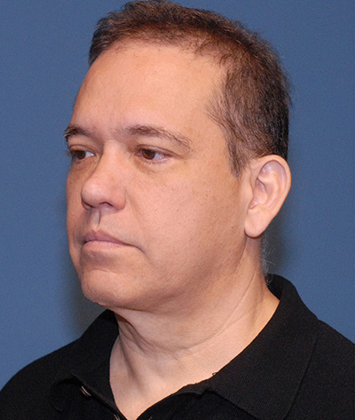 Blepharoplasty Before & After Image