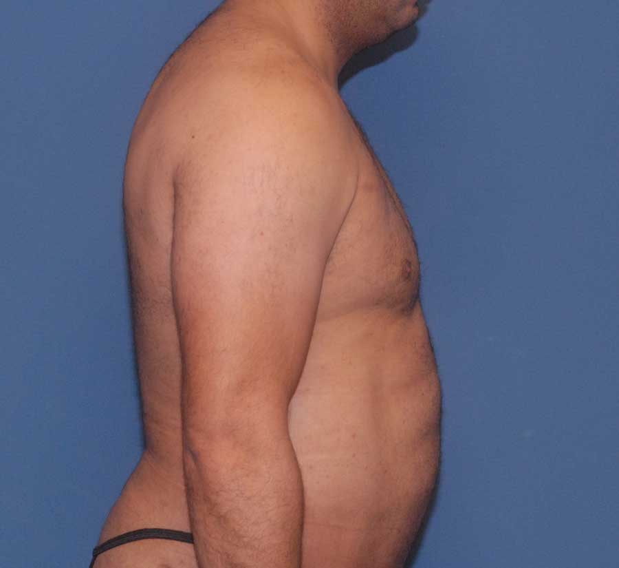 Gynecomastia  Before & After Image