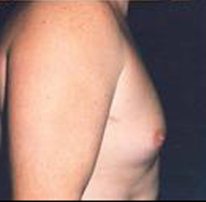 Gynecomastia  Before & After Image