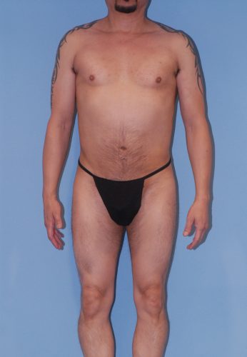 Male Body Contouring  Before & After Image