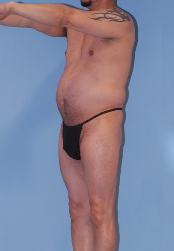 Male Body Contouring  Before & After Image