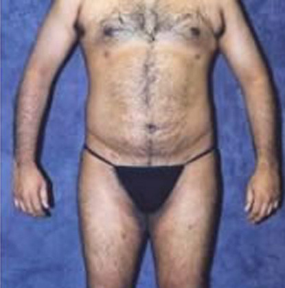 Male Body Contouring  Before & After Image