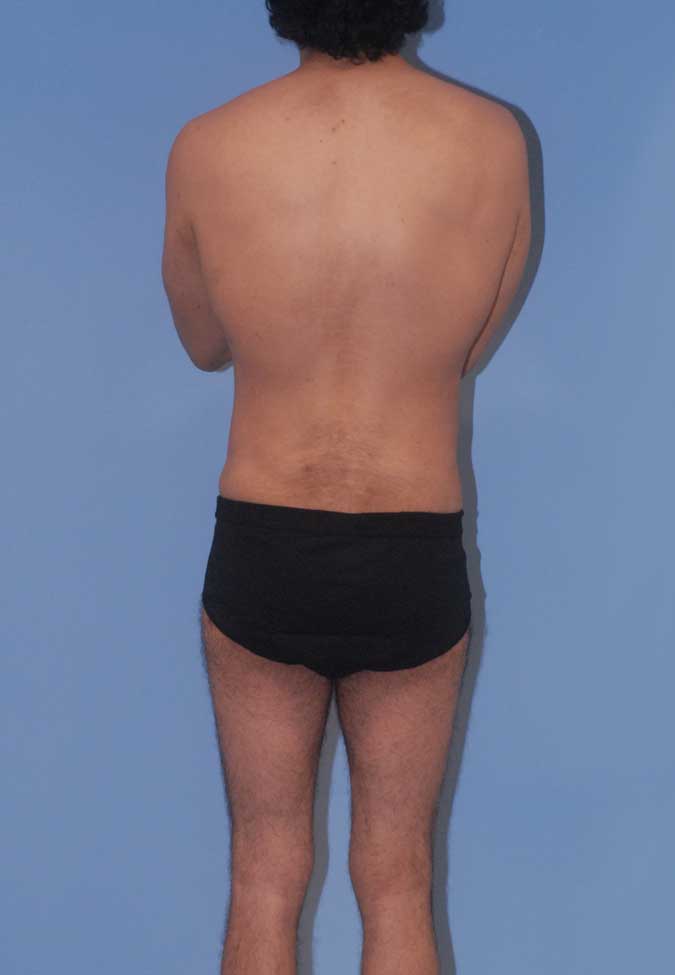 Male Body Contouring  Before & After Image