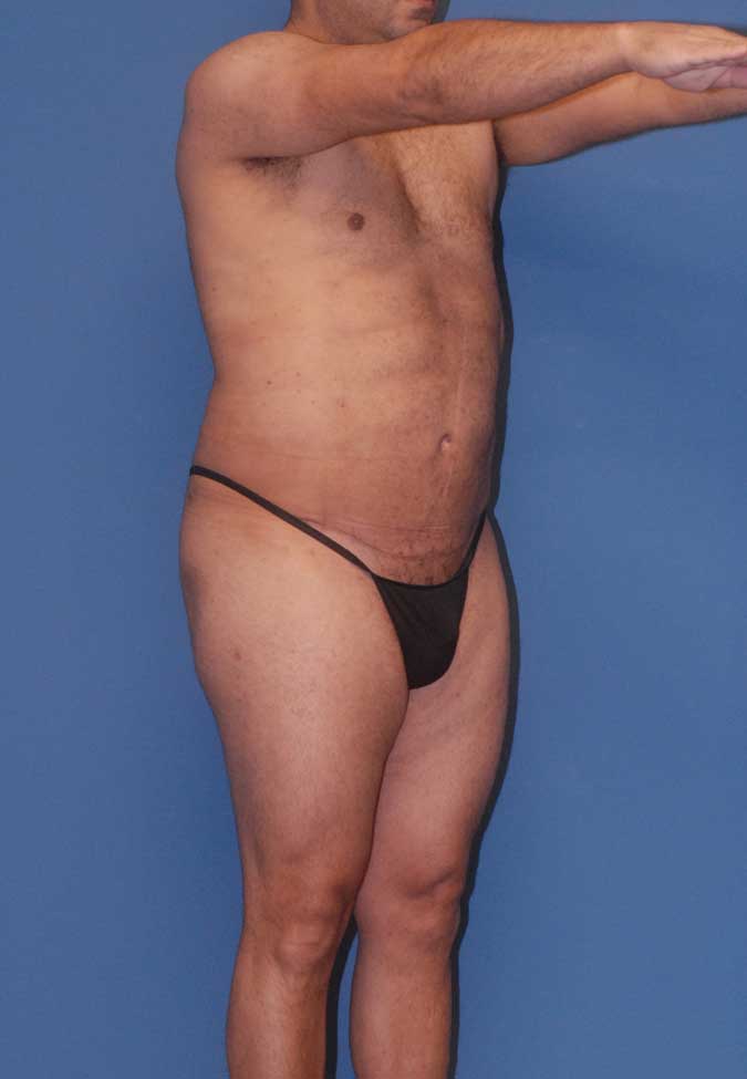 Male Body Contouring  Before & After Image