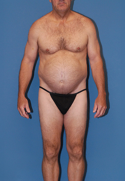 Male Body Contouring  Before & After Image