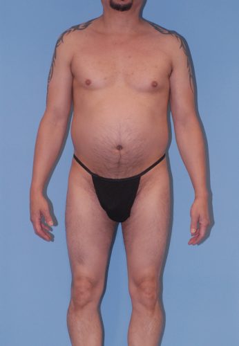 Male Body Contouring  Before & After Image