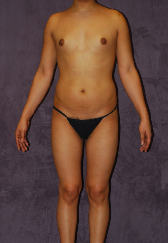 Male To Female Body Contouring Before & After Image
