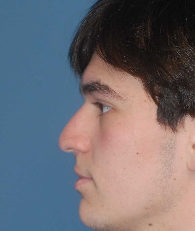 Rhinoplasty Before & After Image