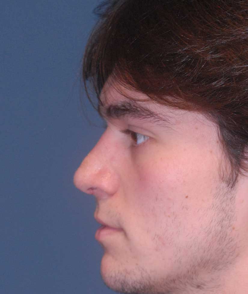 Rhinoplasty Before & After Image