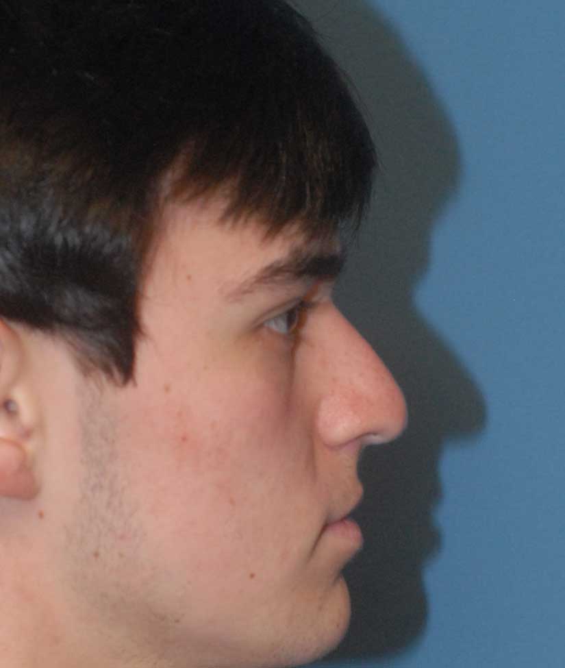 Rhinoplasty Before & After Image