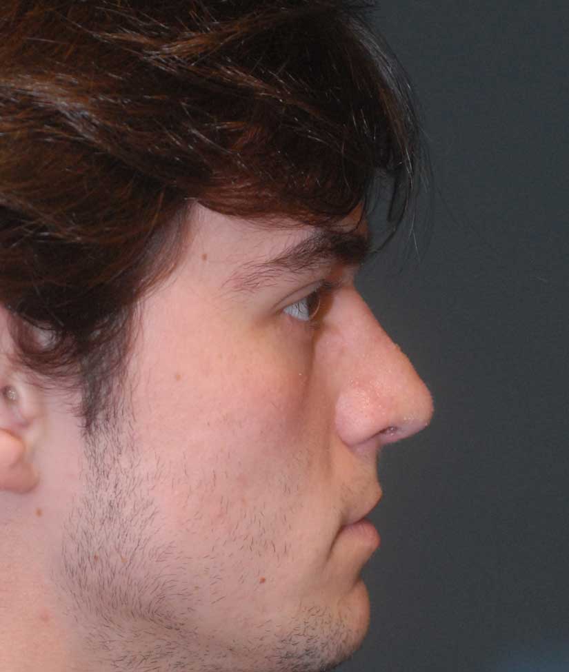 Rhinoplasty Before & After Image