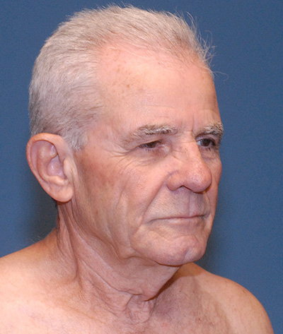 TZ Plasty Before & After Image