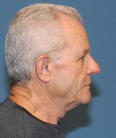 TZ Plasty Before & After Image