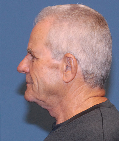 TZ Plasty Before & After Image