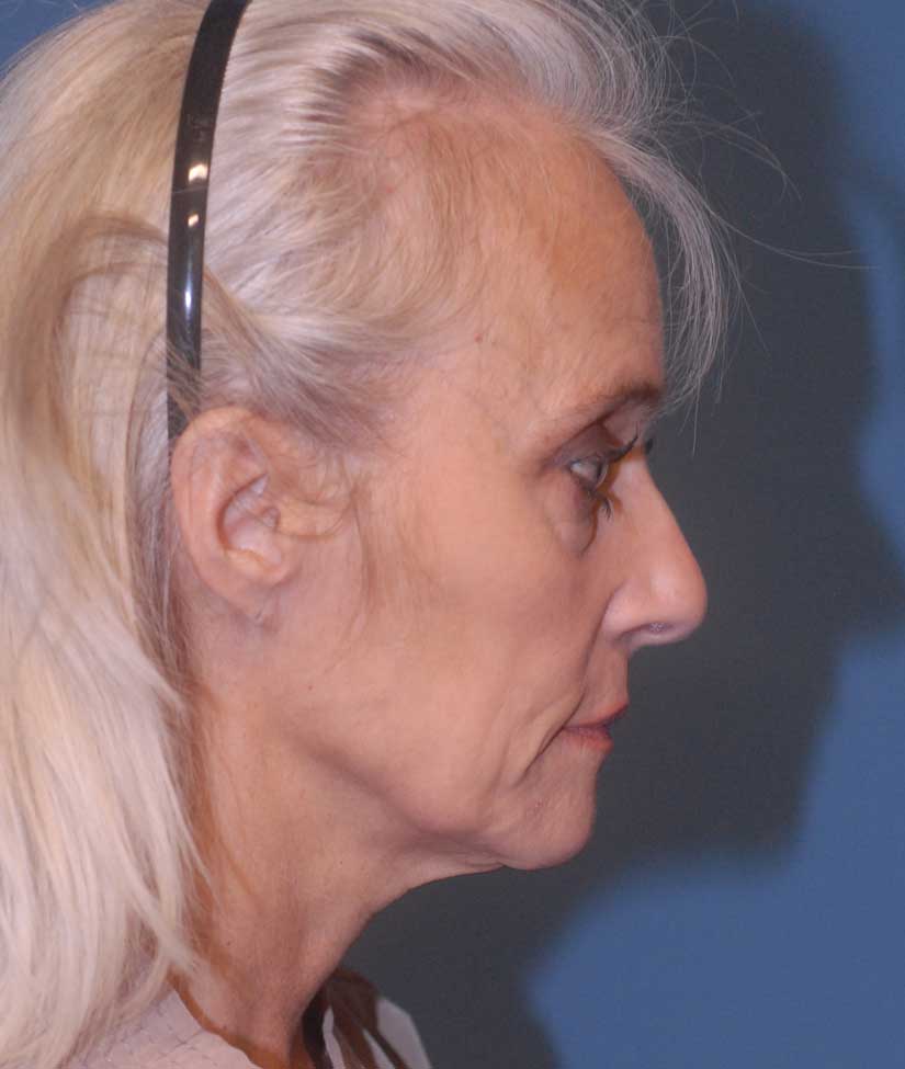 Face Resurfacing Before & After Image