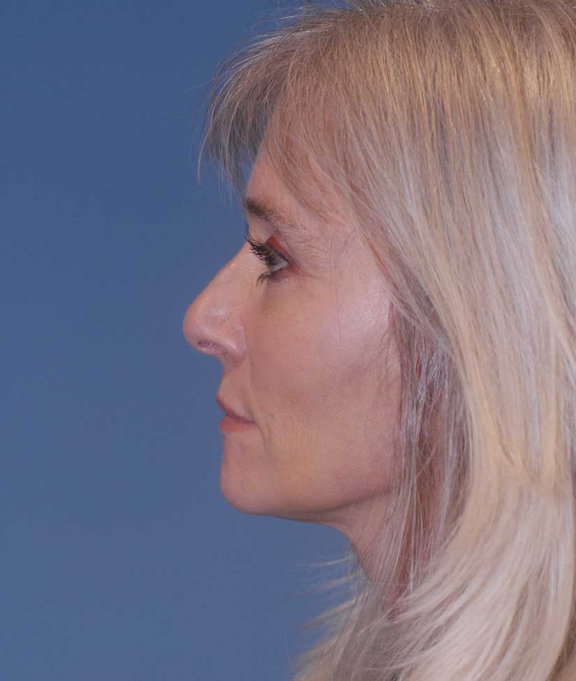 Face Resurfacing Before & After Image