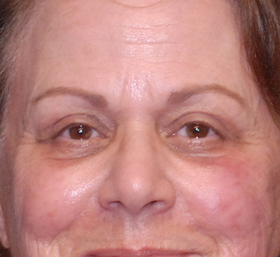 Face Resurfacing Before & After Image