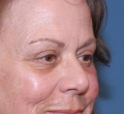 Face Resurfacing Before & After Image