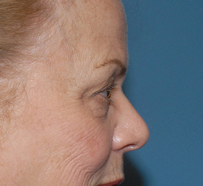 Face Resurfacing Before & After Image