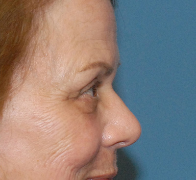 Face Resurfacing Before & After Image