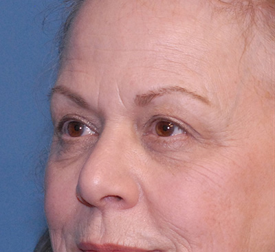 Face Resurfacing Before & After Image