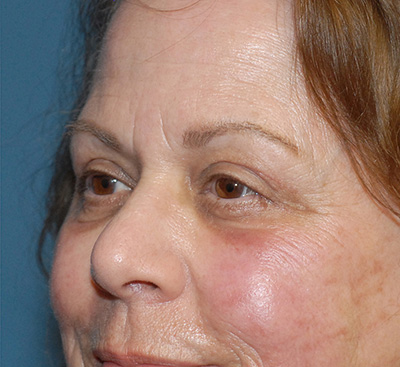 Face Resurfacing Before & After Image