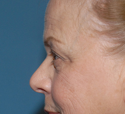 Face Resurfacing Before & After Image